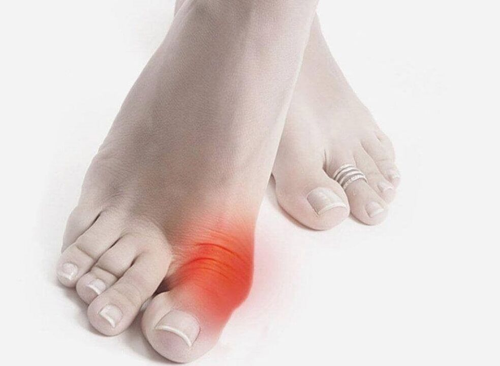 gejala kaki gout