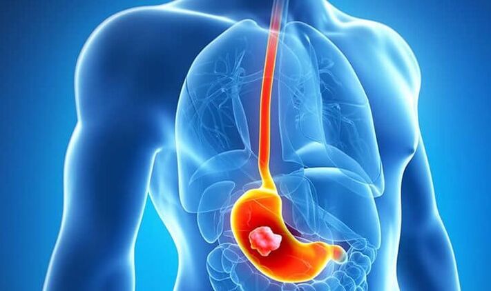 Jika anda mempunyai ulser perut, mengikuti diet Dukan adalah kontraindikasi.